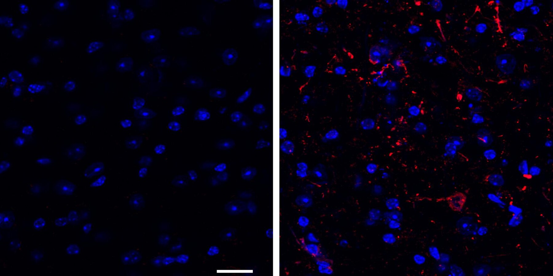 Researchers aimed to prevent buildups of the protein alpha-synuclein (seen in red above) in brain neurons (seen in blue above). Mice that received a therapeutic gene sequence (image on the left) did not accumulate misfolded alpha-synuclein buildups. 