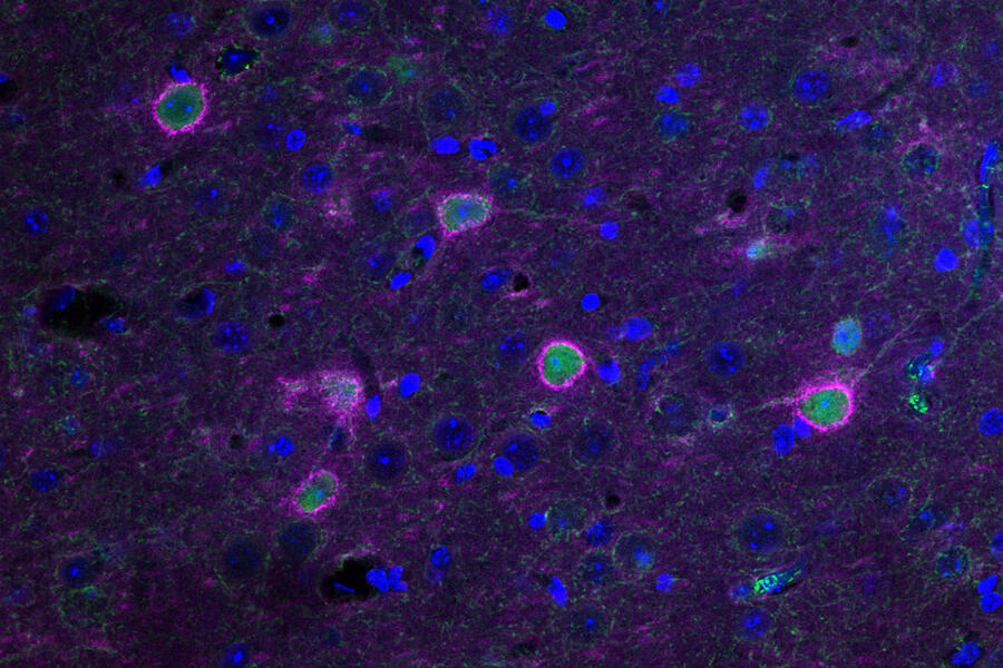 CHEMOGENETICS RESCUES THE HEALTH OF PERINEURONAL NETS IN PINK THAT SURROUNDS NEURONS IN GREEN IN THE ALS MOUSE BRAIN.